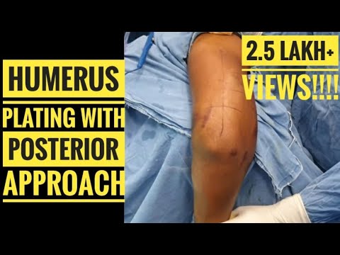 Humerus Plating with Posterior Approach (Detailed Step by Step Approach)