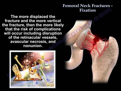 Femoral Neck Fractures Fixation - Everything You Need To Know - Dr. Nabil Ebraheim