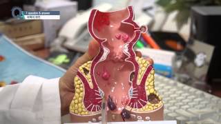 [기획취재] 치핵, 원인은 무엇일까?