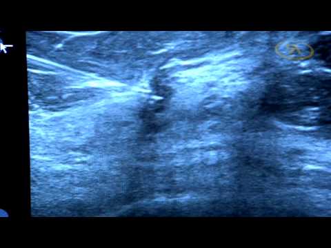 Den Grad der benignen Prostatahyperplasie Bestimmung Methoden für Prostata-Untersuchungen