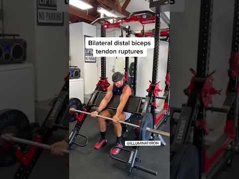 Bilateral Distal Biceps Tendon Rupture (RARE) #shorts
