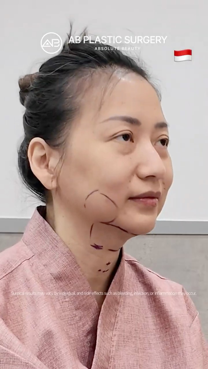 One Lifting Surgery, Total Face Upgrade