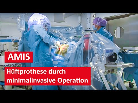 Hüftprothese durch minimalinvasive AMIS Methode - Live Operation