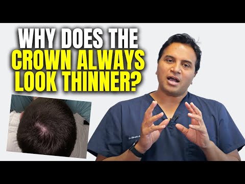 Why Does The Crown Area Always Look Empty?