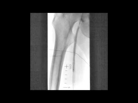 In-stent SFA occlusion treated with laser and PTA