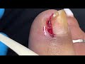 EXTRACTION OF A MAMMOTH INGROWN TOENAIL