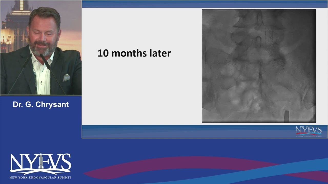 Stent of Choice for Iliac Artery Intervention  Data Available, and how Does Data Influence My Decisi