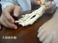 國中女穿高跟鞋罹槌狀趾　腳趾關節變形