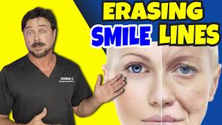 12 MINS🔥 FACE LIFT EXERCISES for Smile Lines & Lip Wrinkles! Try This