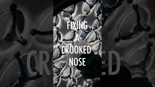 Fixing A Crooked Nose #rhinoplasty #crookednose #nosejob #septum #sept