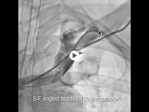 Femoral access to help cross a subclavian occlusion for venoplasty case sheshug 2018 AUDIO
