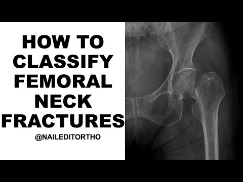 How to Classify Femoral Neck Fractures