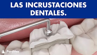 Incrustaciones dentales © - Clínica Dental Pardiñas