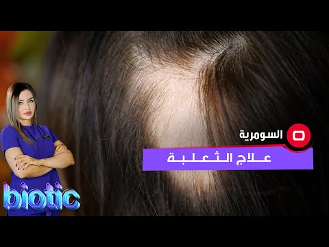 شاهد بالفيديو.. علاج الثعلبة