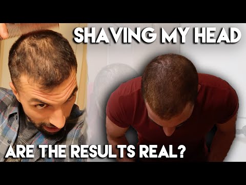 Rogaine/Minoxidil Month 8 Results | SHAVING MY HEAD!