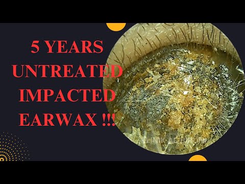 5 YEARS Untreated Impacted Earwax (Very Satisfying Result)