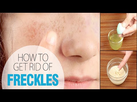 How to Get Rid of Freckles Fast || Home Remedies for...