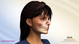 preview picture of video 'Different Types of Jaw Surgery - Surgical Orthodontics'