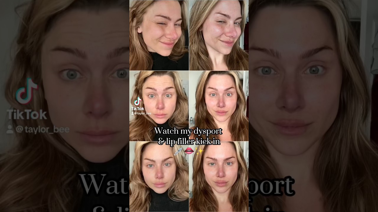 Watch my lip filler & Dysport set in | daily progress