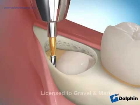 comment soulager douleur apres extraction dents sagesse