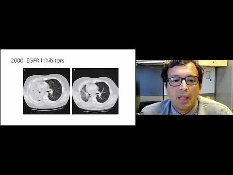 "Lung Cancer 25 Years Later" presented by Dr. Renato Martins