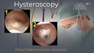 Histeroscopic Focal Adenomyosis Scissors Resection