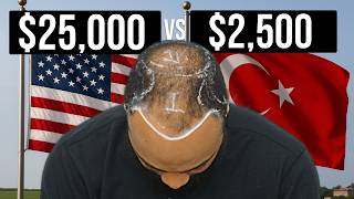 Turkey vs USA Hair Transplant *Costs, Pain, and Travel*