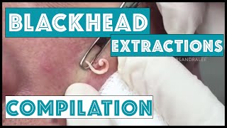 Long and Satisfying Blackhead Extractions: A Dr Pimple Popper Compilation