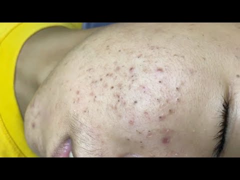 Complete Blackhead Removal – 60 minutes