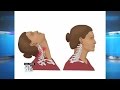 Beauty Parlor Stroke Syndrome