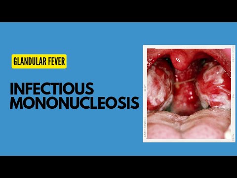 Infectious Mononucleosis