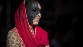 Birthmark Has Destroyed My Life