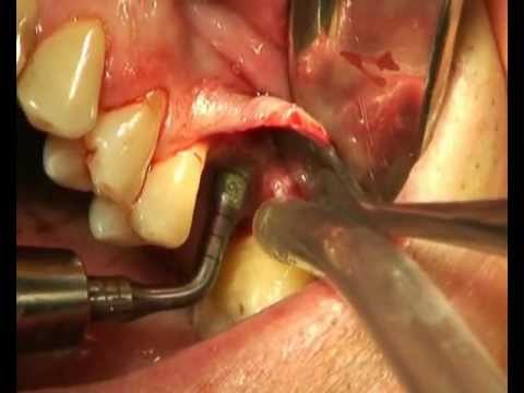 Image for Video Internal Sinus Lift Procedure