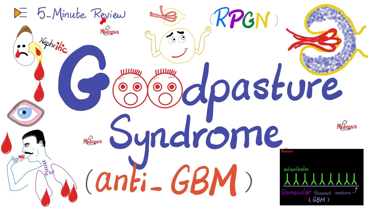 Goodpasture Syndrome | Anti-Glomerular Basement Membrane (Anti-GBM) Antibody Disease | Nephrology