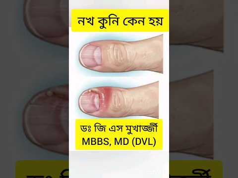 Paronychia || Nail problem|| Dr G S Mukherjee|| #dermatologist #skinspecialist #doctor #bengali