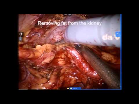 Robotic Assisted Pyeloplasty 