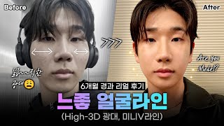 [리얼모델 VLOG] 느좋남입니다｜윤곽 2종(광대, 턱끝) 6개월 리얼 후기 #일퍼센트성형외과