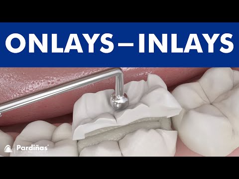 download lagu mp3 mp4 Tooth Inlay Vs Filling, download lagu Tooth Inlay Vs Filling gratis, unduh video klip Tooth Inlay Vs Filling