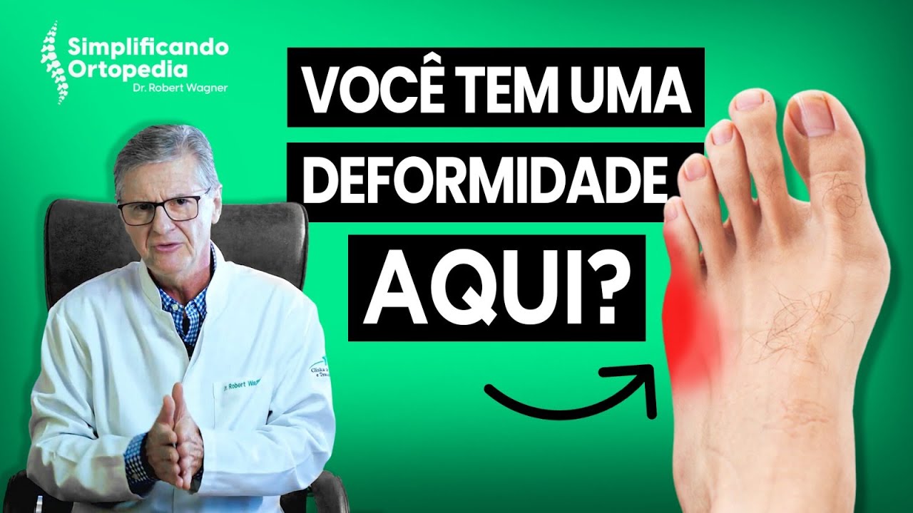 Joanete do Quinto Dedo: Tudo o que você precisa saber!