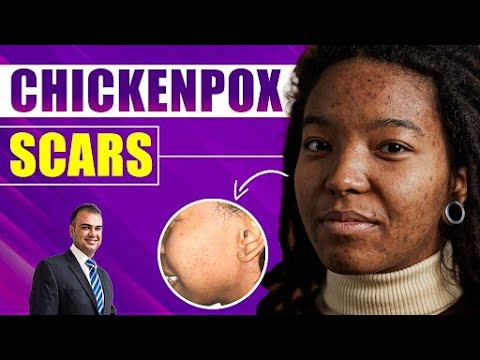 Chickenpox Scars: PRP & Microneedling Treatment