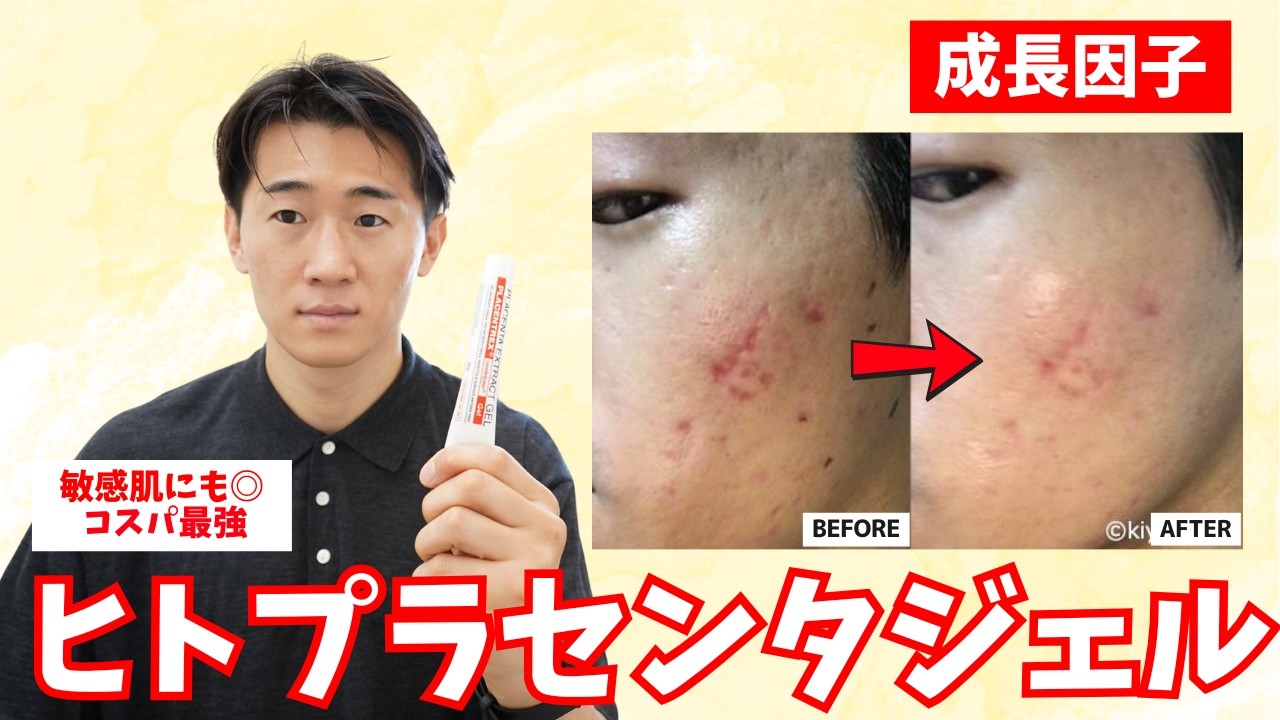 【コスパ最強】ヒトプラセンタジェルを3ヶ月毎日塗った経過がヤバい、、【成長因子】
