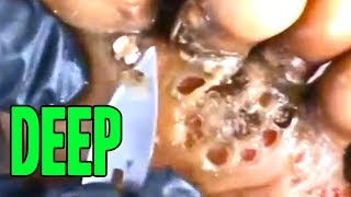 Tungiasis Treatment - Andrew's Jigger Removal Set to Lullaby