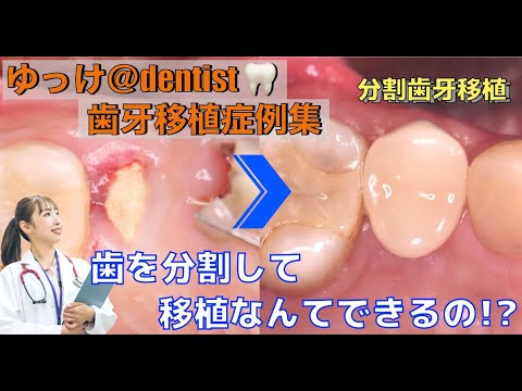 生命歯学科 矯正したのに歯がボロボロ‥‥。抜歯した歯を再利用！？保存不可能な歯を分割して移植歯として歯牙移植に利用🦷歯の欠損部をインプラントではなくご自身の歯を利用して残す歯牙移植法を大公開‼️