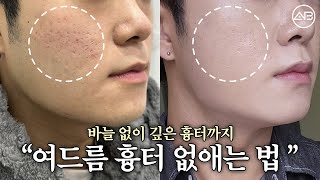 여드름 흉터 뿌시는 법❗