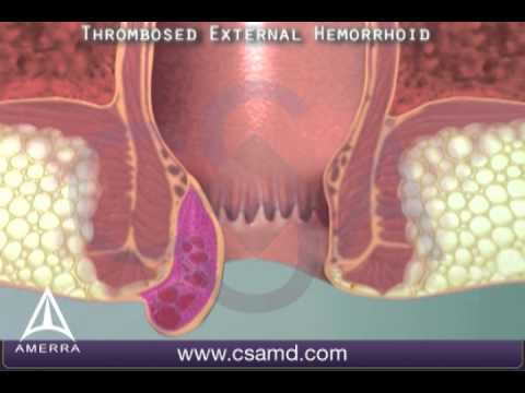 Thrombosed External Hemorrhoid - 3D Medical Animation