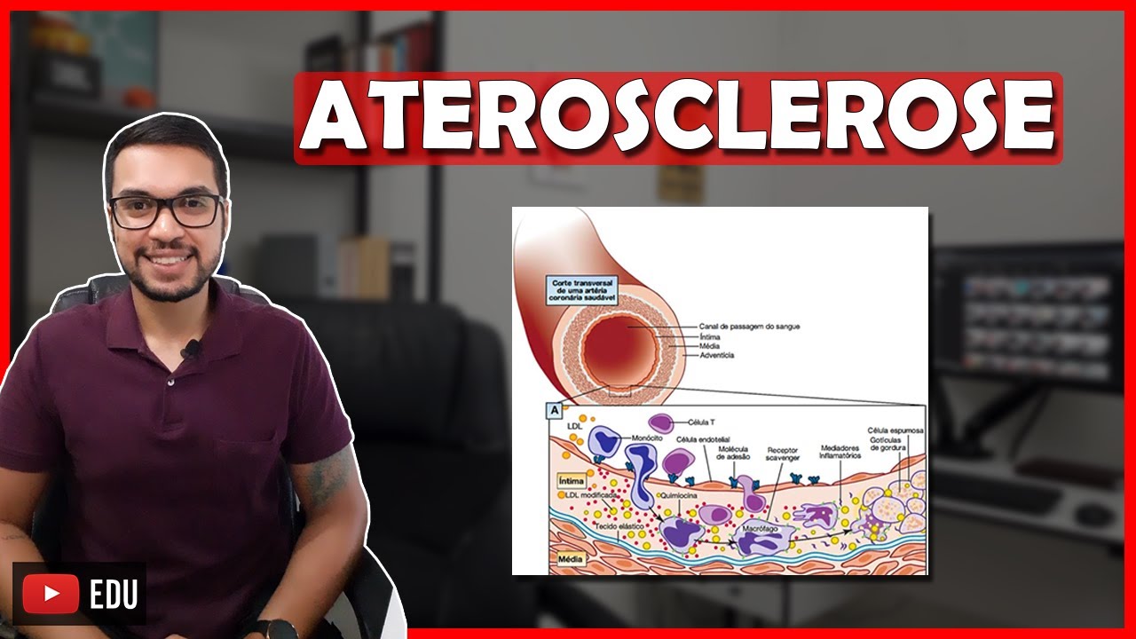 COMO OCORRE A ATEROSCLEROSE [Cardio 20]