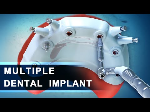 Dental Implant | Advanced Multiple  | 3d  Dental Animation