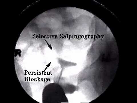 Blocked Tubes How to Avoid IVF and Surgery Fertility Expert Dr Randy Morris