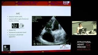 Right-Sided Rheumatic Heart Disease – Dr Edwina Wing Lun
