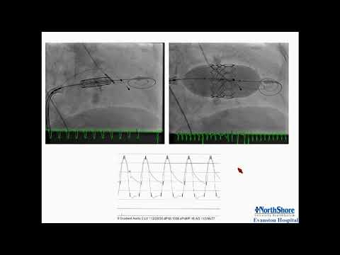 Transcatheter MVR for MAC - Mayra Guerrero, MD